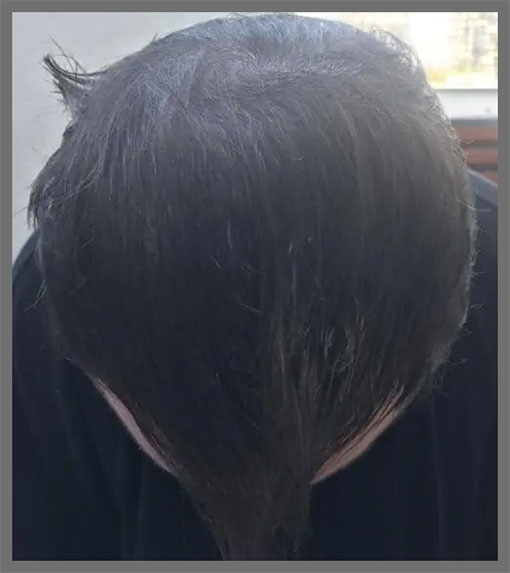 Bills's wet hair after propecia 5 mg